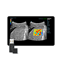 STE (Sound Touch Elastography)